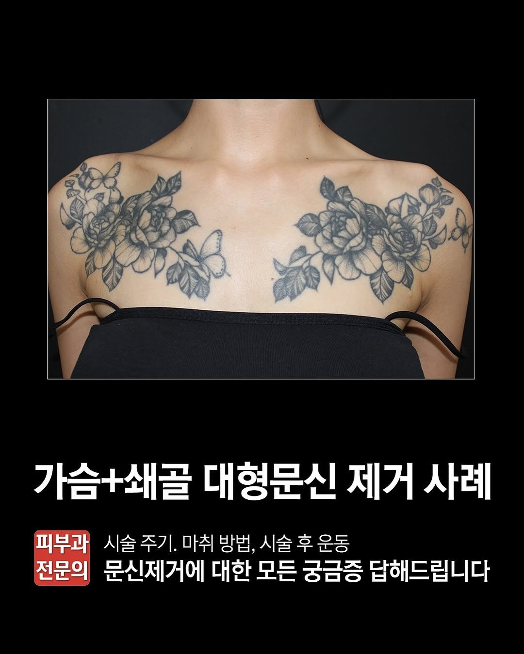 Photo by 주 on March 07, 2026. May be an image of text that says '가슴+쇄골 대형문신 제거 사례 피부과 시술주기. 시술 주기 마취 방법, 시술후운동 시술후 후 운동 전문의 문신제거에 대한 모든 궁금증 답해드립니다'.