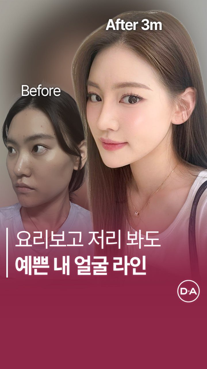 da_plastic_surgery 게시물 이미지: 요리보고 저리 봐도 예쁜 갸름한 내 얼굴 😉💚

💌상담문의
전화...