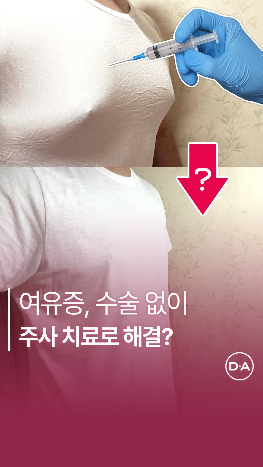da_plastic_surgery 게시물 이미지: 주사로 “여유증” 치료 될까? 💉
💌상담문의
전화 02-515-4600
카톡...