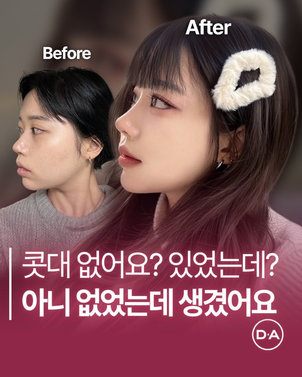 Photo by 예쁘면 DA야! 디에이성형외과 on February 05, 2026. May be an image of text that says 'Before After 콧대 없어요? 있었는데? 아니 없었는데 생겼어요 D.A'.