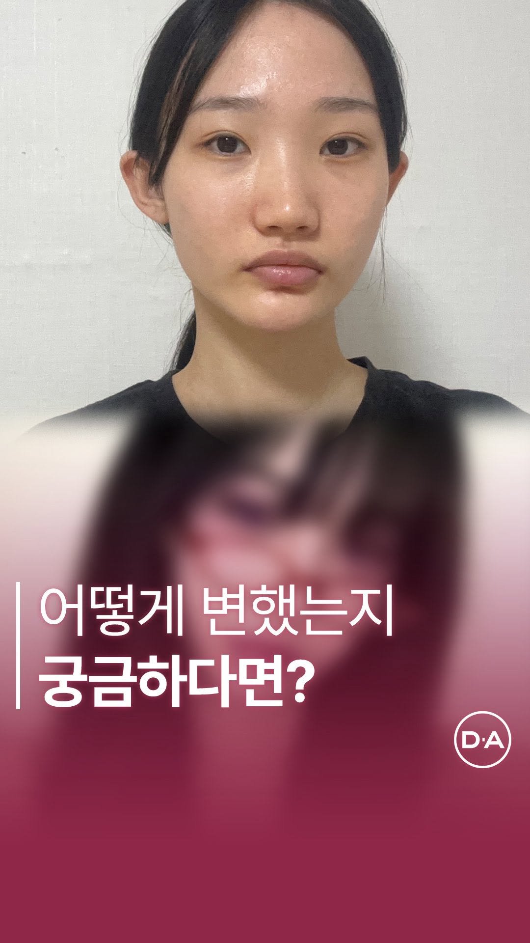 da_plastic_surgery 게시물 이미지: 점을 따라가보세요...? 👀

💌상담문의
전화 02-515-4600
카톡...