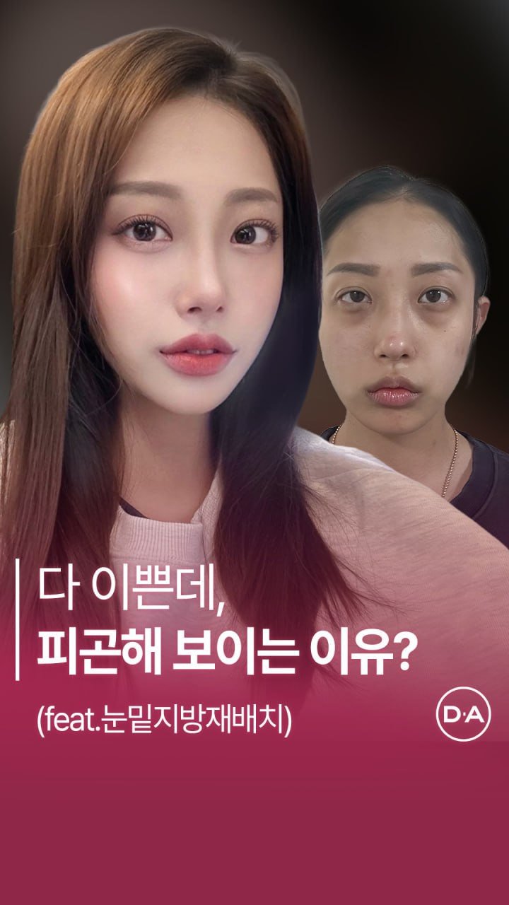 da_plastic_surgery 게시물 이미지: 얼굴 다 이쁜데, 눈밑 한 곳만 안이뻐 😢

💌상담문의
전화...