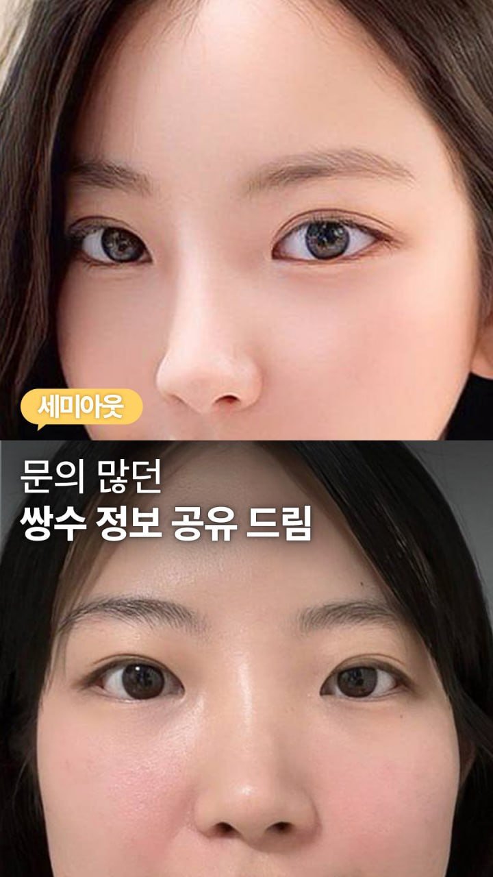 da_plastic_surgery 게시물 이미지: 쌍수 정보 공유 드림 😉

💌상담문의
전화 02-515-4600
카톡...