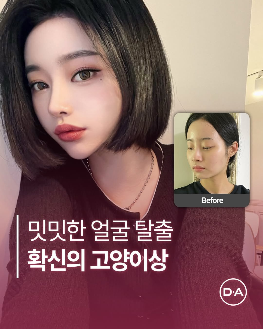 Photo by 예쁘면 DA야! 디에이성형외과 in 디에이성형외과. May be an image of 2 people and text that says 'Before 밋밋한 얼굴 탈출 확신의 고양이상 D.A DA D'.