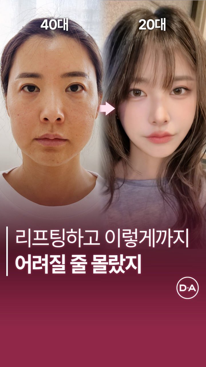 da_plastic_surgery 게시물 이미지: 리프팅하고 이렇게까지 어려진다고 ⁉️

💌상담문의
전화 02-515-4600
카톡...