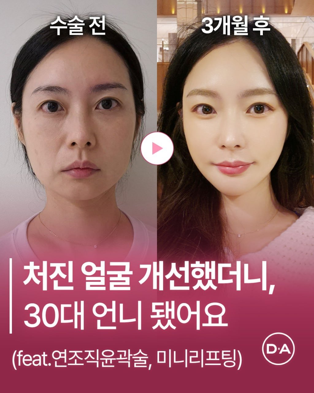 Photo by 예쁘면 DA야! 디에이성형외과 on February 03, 2026. May be an image of text that says '수술전 전 3개월후 후 처진 얼굴 개선했더니, 30대 언니 됐어요 (feat. 연조직윤곽술, 미니리프팅) D.A'.