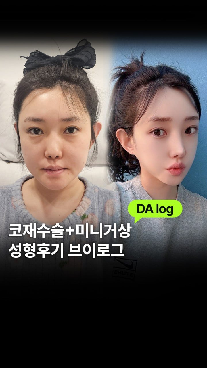 da_plastic_surgery 게시물 이미지: 코재수술, 미니거상 성형후기 DA 브이로그 ☺️

💌상담문의
전화...