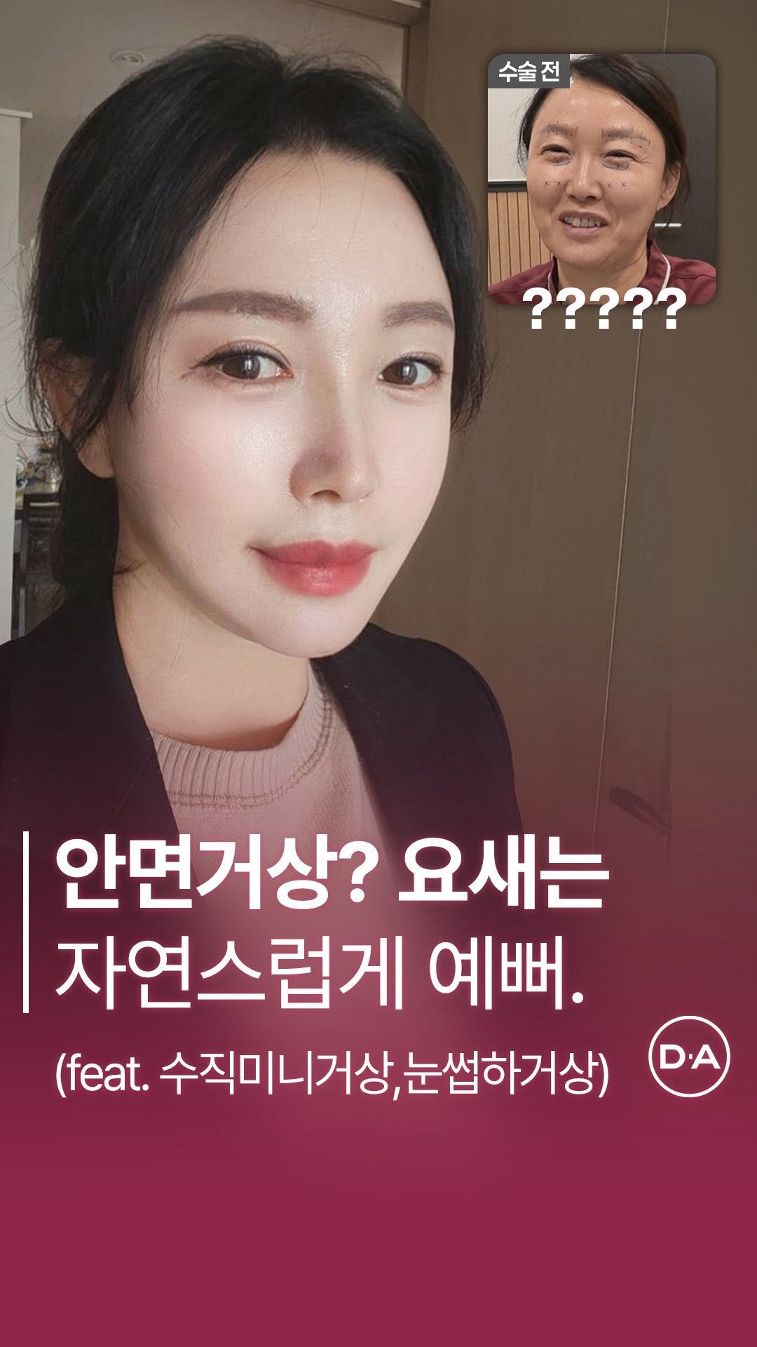 da_plastic_surgery 게시물 이미지: #안면거상 이 이렇게 자연스럽다고? 😳

💌상담문의
전화...