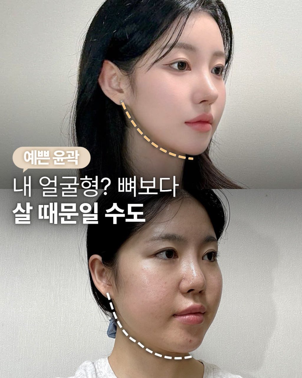 da_plastic_surgery 게시물 이미지: 뼈 깎지 않고 작고 예쁜 얼굴라인 💕

💌상담문의
전화...