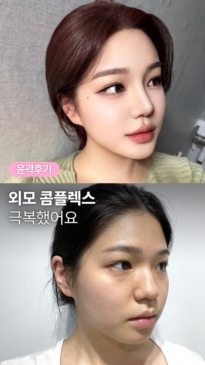 da_plastic_surgery 게시물 이미지: 안면 윤곽하고 외모 콤플렉스 극복 〰️🥹

💌상담문의
전화...