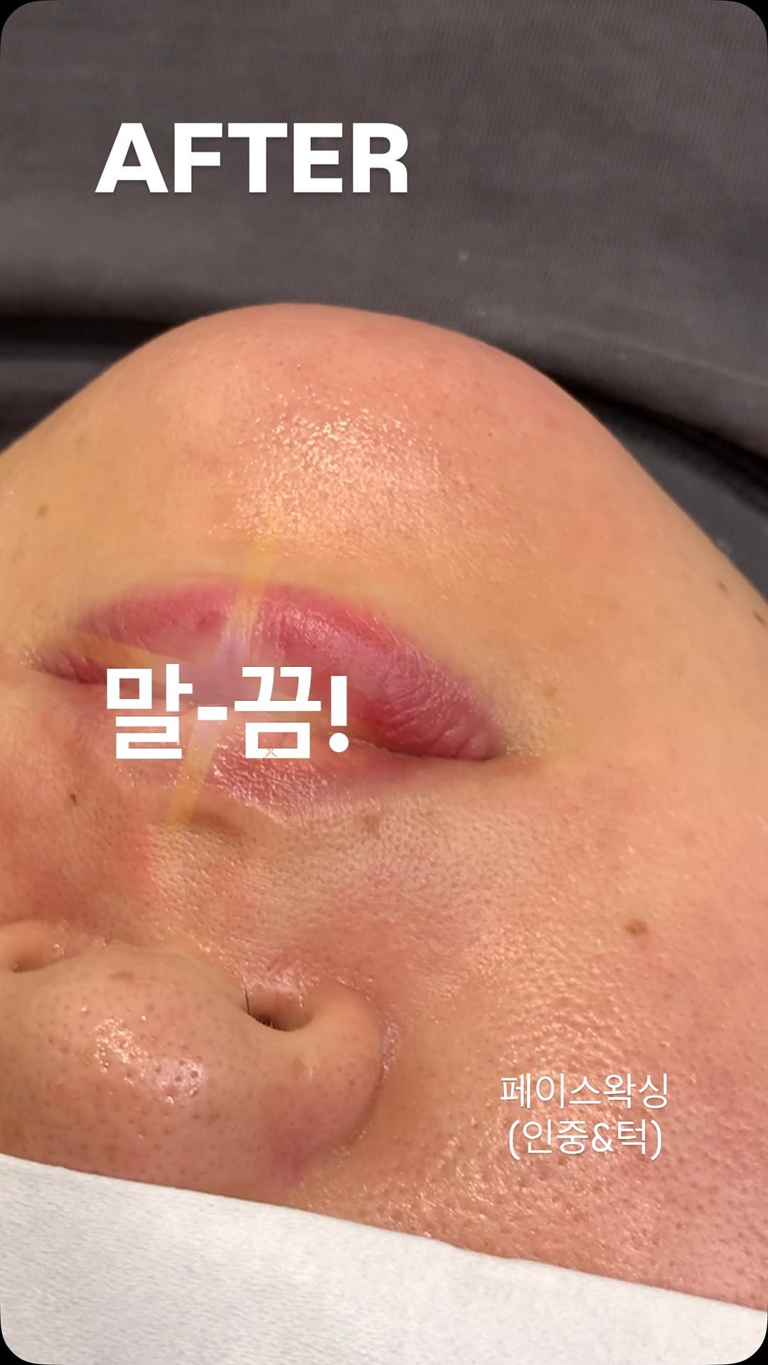 dachaeroe_e 게시물 이미지: 비포 에프터 보시면
왜 페이스왁싱 하는지 바로 이해되실 거예요 👀

은근 길고...