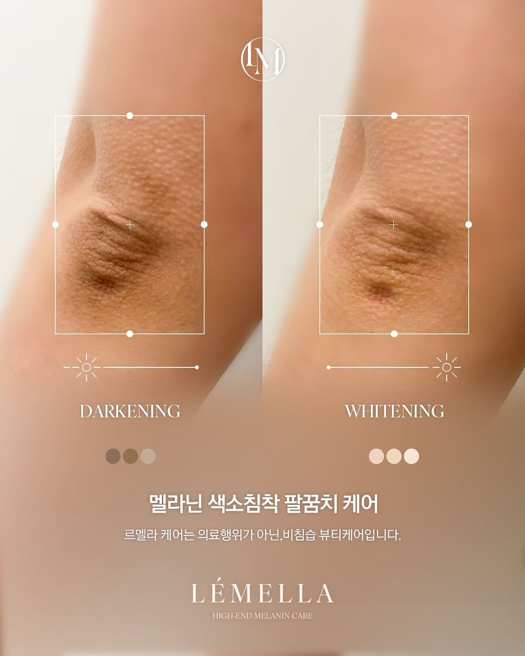 dadeum102 게시물 이미지: 짧은 소매의 계절이 오기 전 팔꿈치 톤 정리부터🤍

거칠어지고 어두워지기 쉬운...