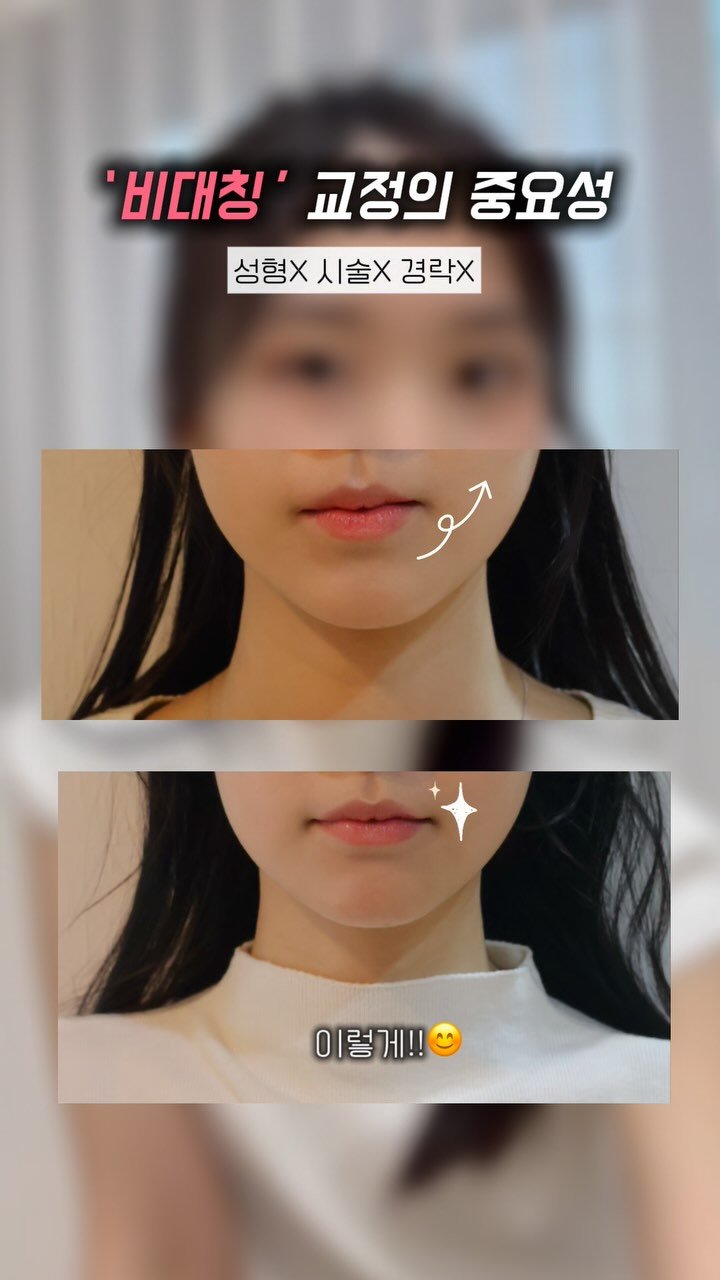 dana_beauty02 게시물 이미지: (공유)👇🏻얼굴형 고민인 친구에게 공유!💖

시술은 볼패임 생기고ㅜ
수술은 무섭고,...