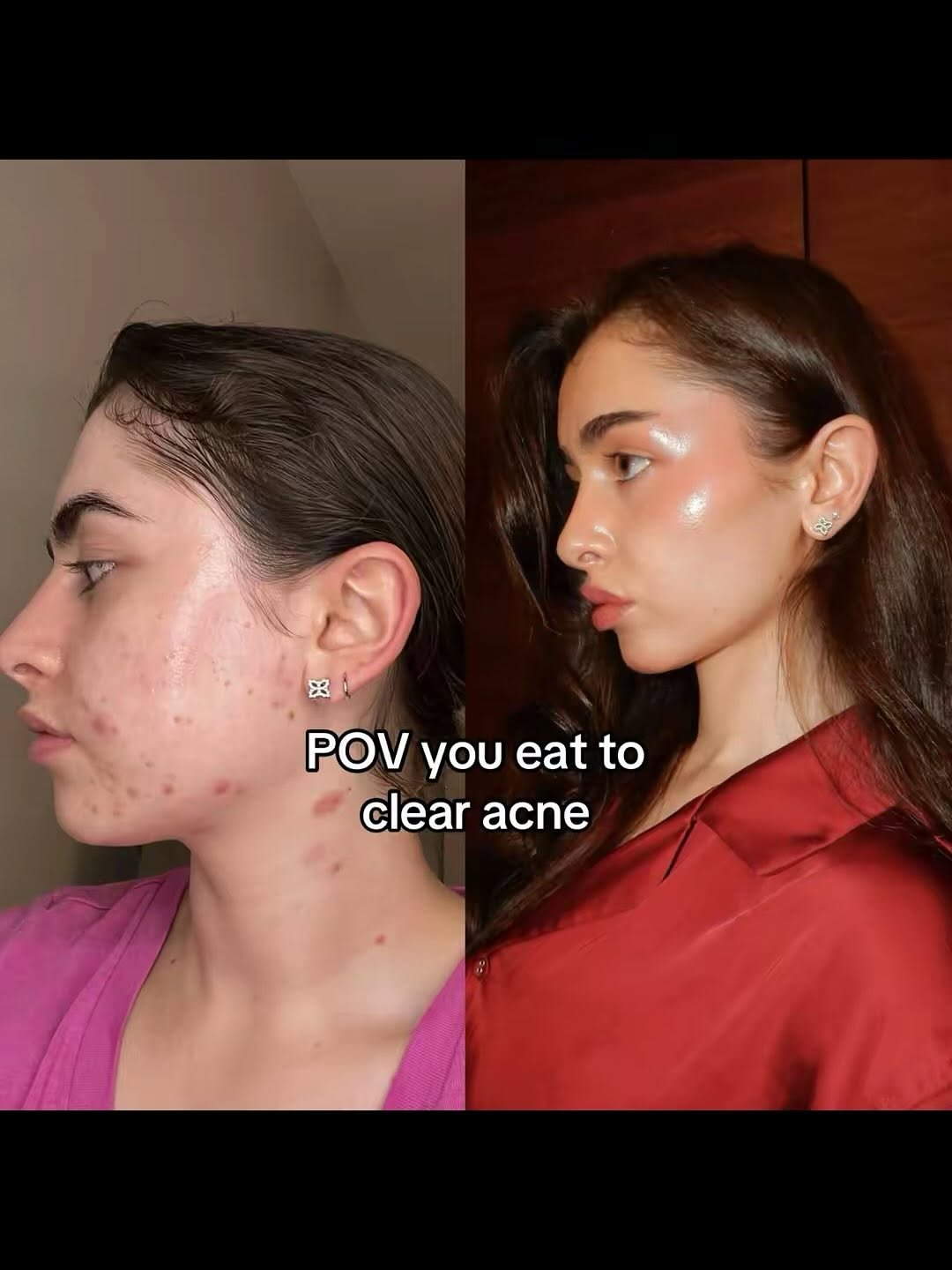 Photo by Dani Cole on March 29, 2026. May be an image of one or more people, makeup and text that says 'ያ POV you eat POVyoueatto to clear clearacne acne'.