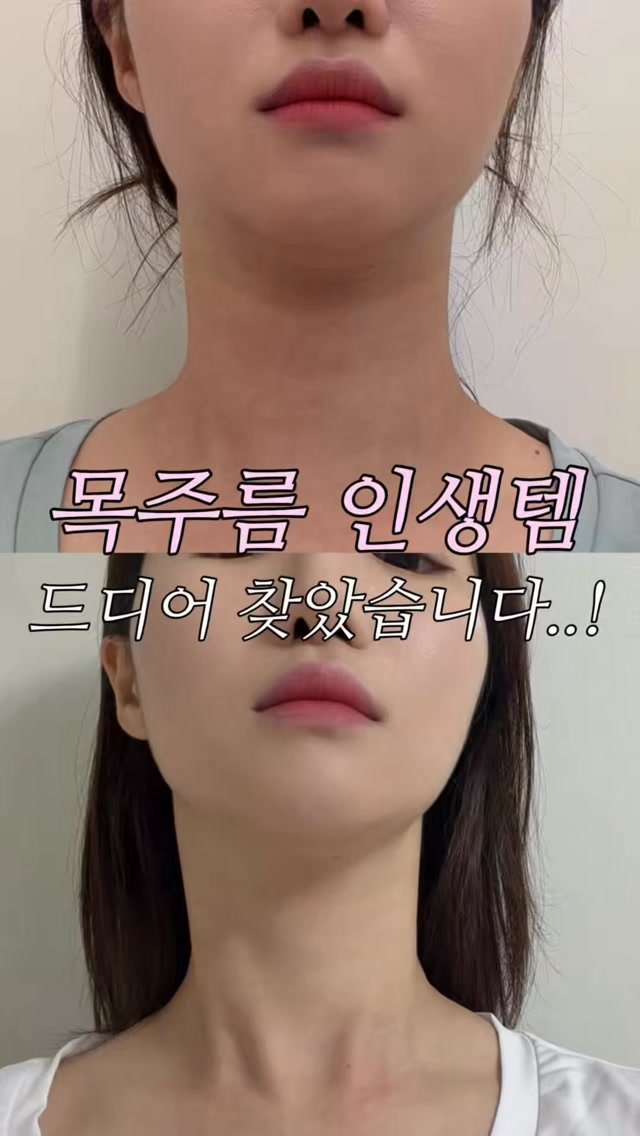 ddua_fitt 게시물 이미지: 목주름 드디어 다 펴졌어요🧏🏻‍♀️
[메디큐브 PDRN 광채주름 2종세트...