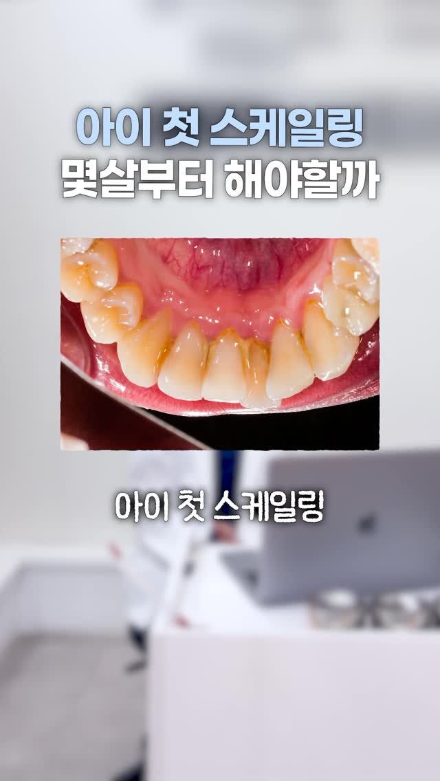 dentist_sujin 게시물 이미지: 아이 스케일링 물어보는 분들 많은데요. 

만 19세 미만이라 
연1회 전체...
