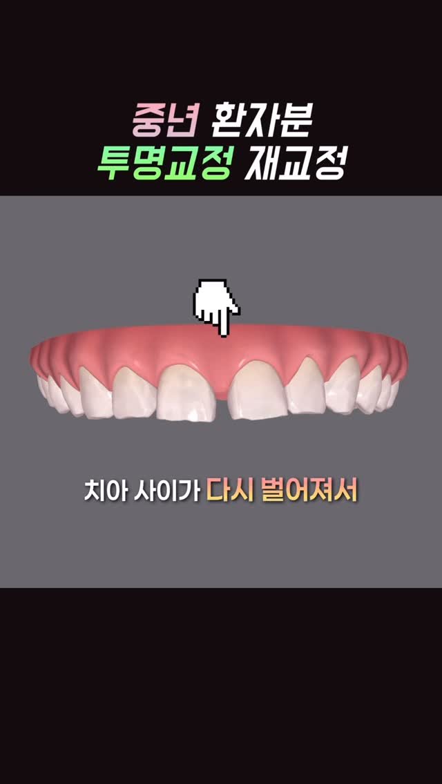 dentist_sujin 게시물 이미지: 입안 3d 스캔 이미지로 보는 교정 전후👩🏻⚕️
오래 전에 교정치료 받고...
