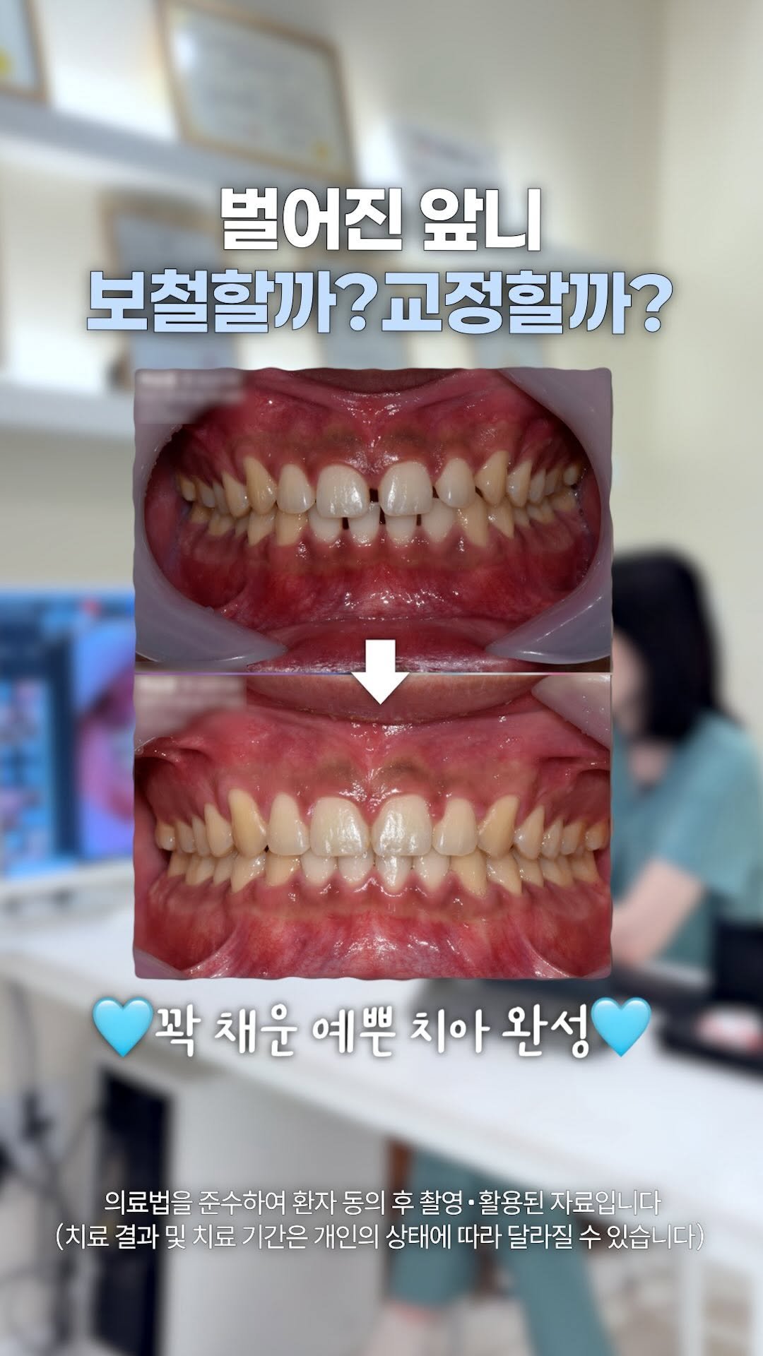 dentist_sujin 게시물 이미지: 벌어진 앞니는 교정 or 크라운 보철?!

정답은 없지만, 선택하실 수 있도록...