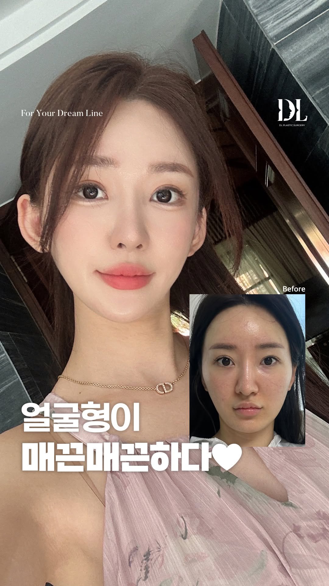 dl_plastic_official 게시물 이미지: 매끈매끈한 얼굴형을 원한다면? 댓글에 '얼굴형'을 달아주세요💕

매끈매끈하다...