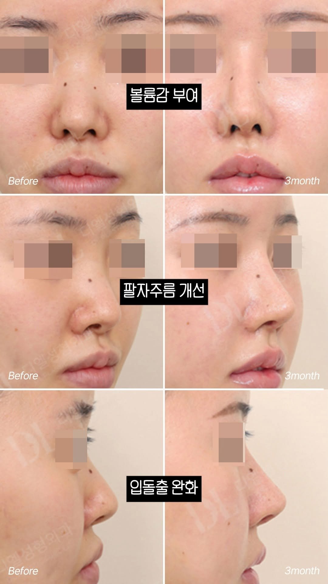 dl_plastic_official 게시물 이미지: 귀족 보형물 효과가 왜이리 많아...👀! 자세한 상담이 필요한 분들은 댓글에...