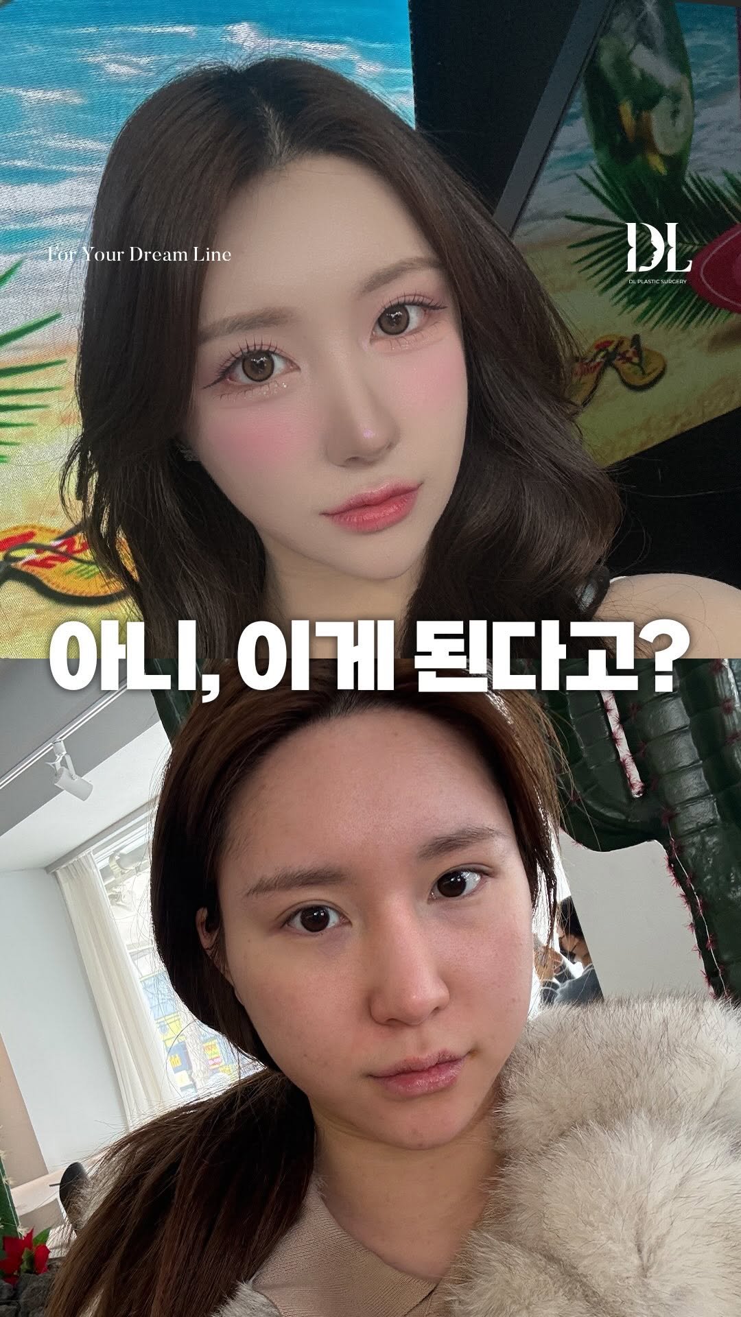 dl_plastic_official 게시물 이미지: 자세한 수술 내용이 궁금하다면 댓글에 ’예뻐요‘을 남겨주세요🫰🏻🫰🏻
하지만 해냈죠?...