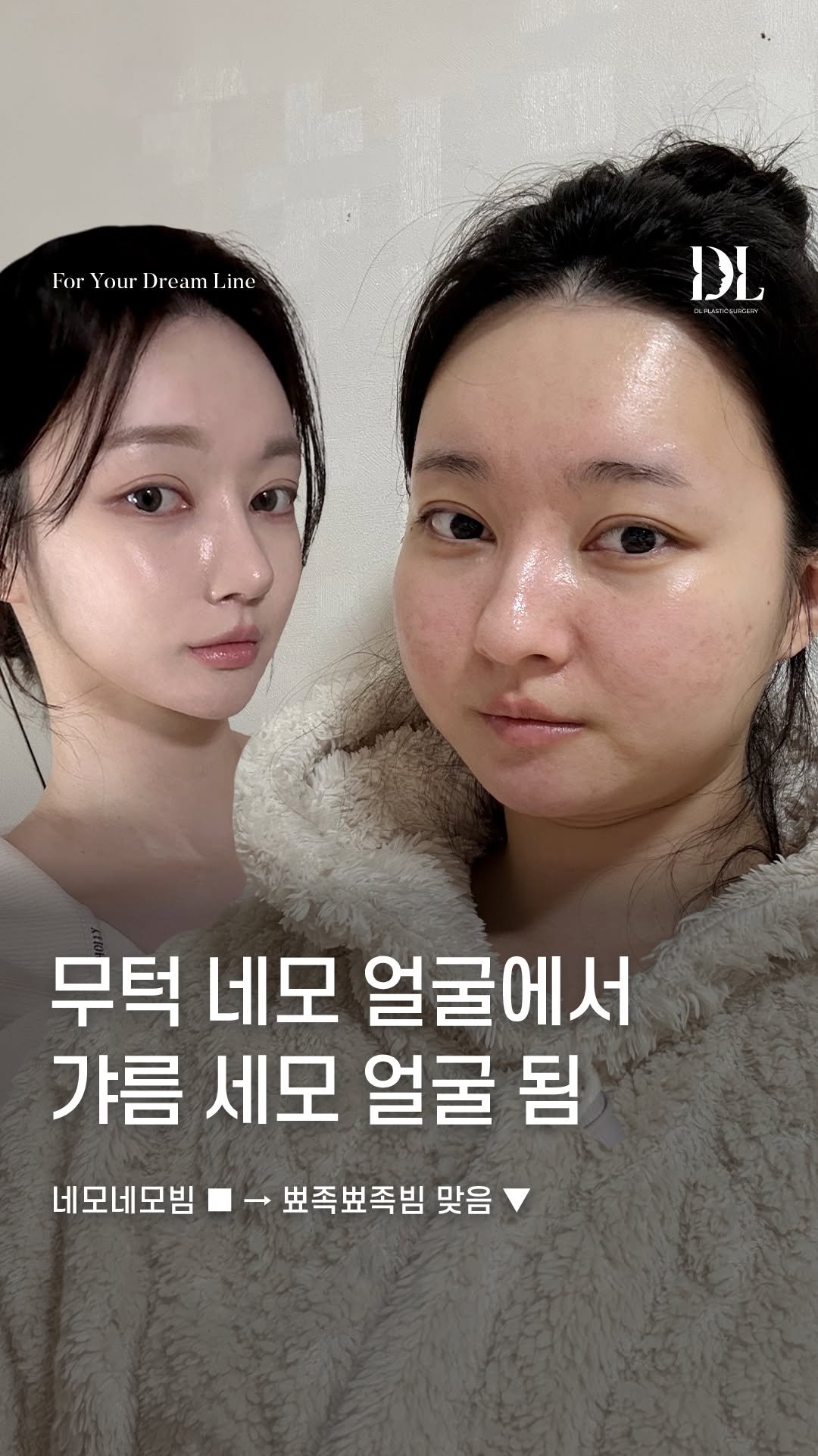 dl_plastic_official 게시물 이미지: #정보공유 네모네모 얼굴형에서 갸름 세모 얼굴된 정보가 궁금하다면 "무턱"이라고...