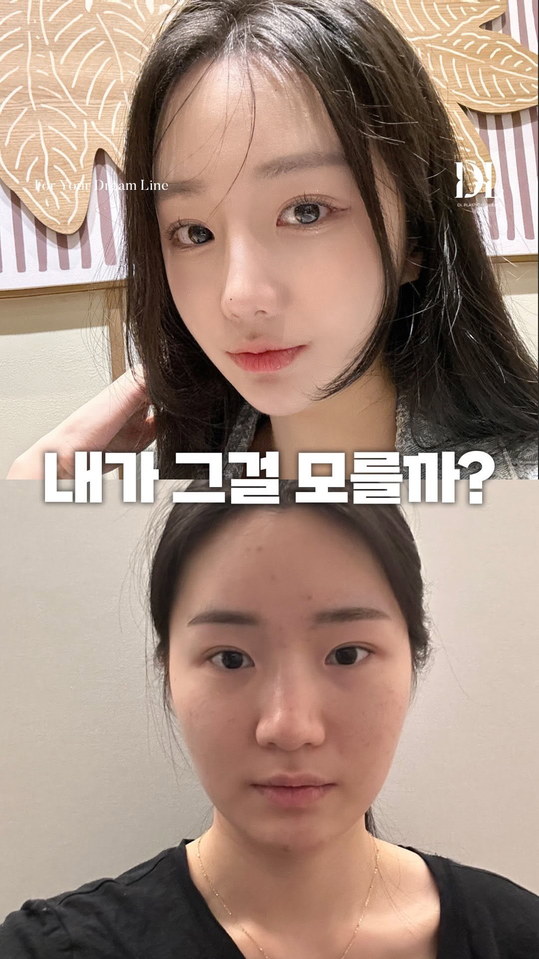 dl_plastic_official 게시물 이미지: 내가 ? 내가 그걸 모를까 ?? 엏
어디 했는지 맞춰봐 ㅎ

수술 내용이 궁금하다면...