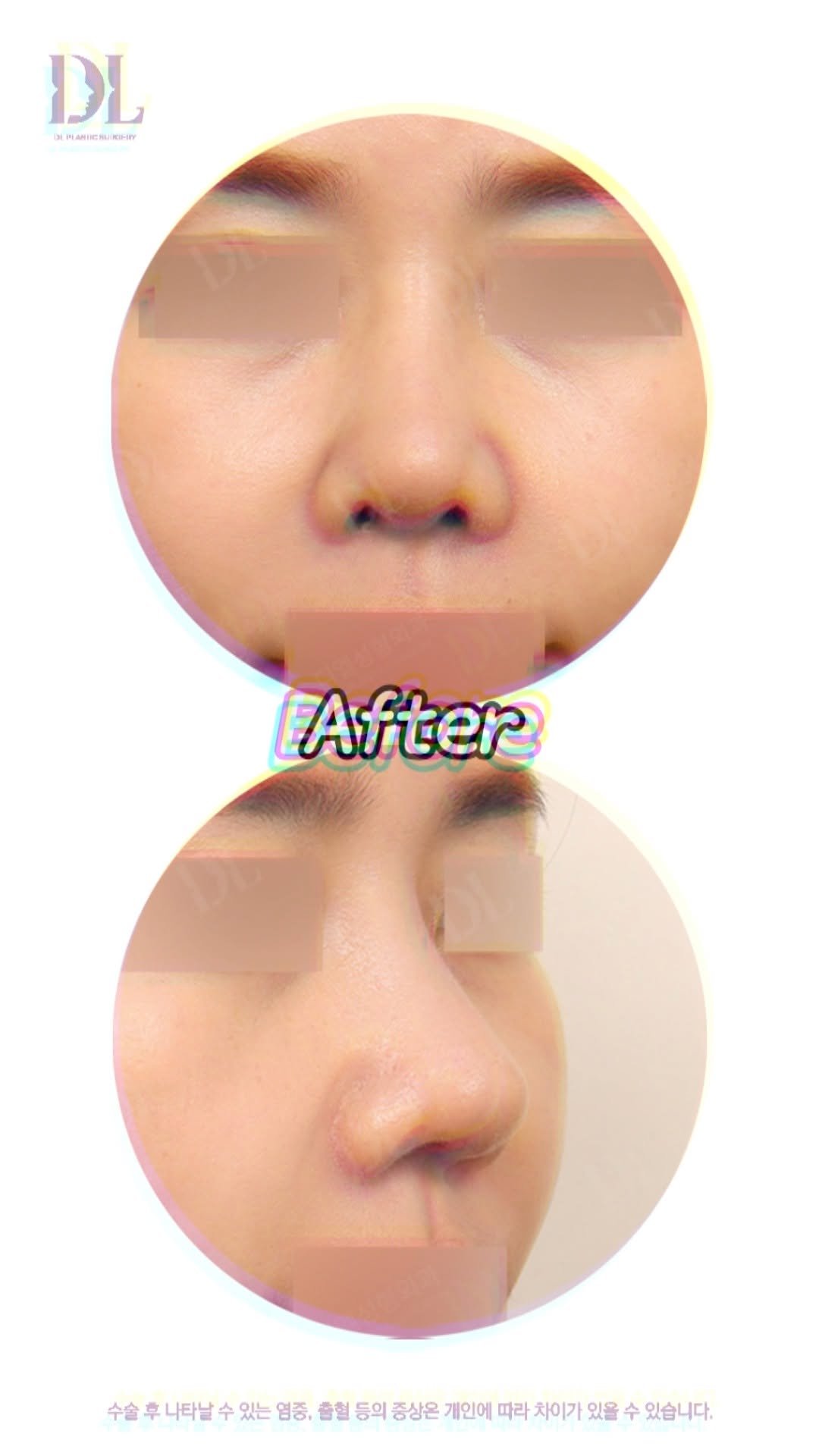 dl_plastic_official 게시물 이미지: 찝힌코, 들린코 고민 해결✨ 수술 내용이 궁금하다면 댓글에 '비주'를...