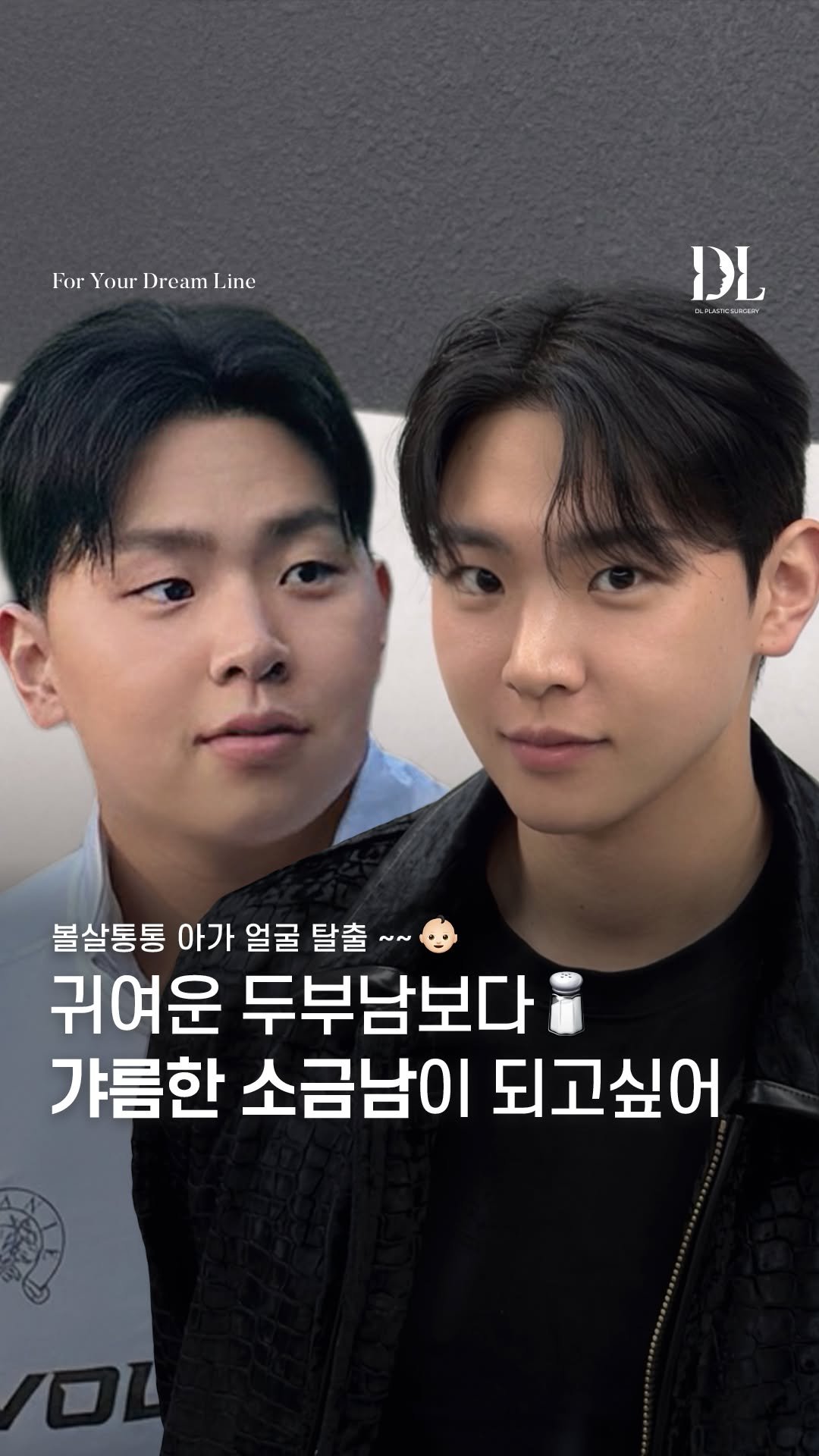 dl_plastic_official 게시물 이미지: #정보공유 볼살통통 투턱이 스트레스였던 두부남이 갸름한 소금남이 된 방법이...