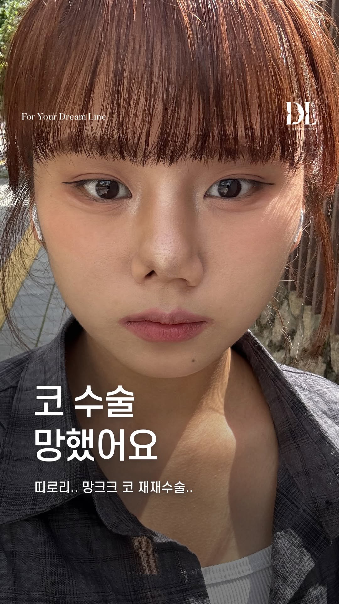 dl_plastic_official 게시물 이미지: #정보공유 망한 코.. 재재수술 성공했어요! 정보가 궁금하다면 댓글에 '구축코재건'...