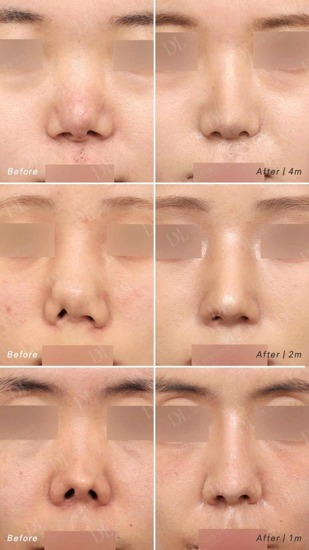 dl_plastic_official 게시물 이미지: 구축코 재건술 모음, 수술내용이 궁금하다면 댓글에 ’구축코재수술‘을...