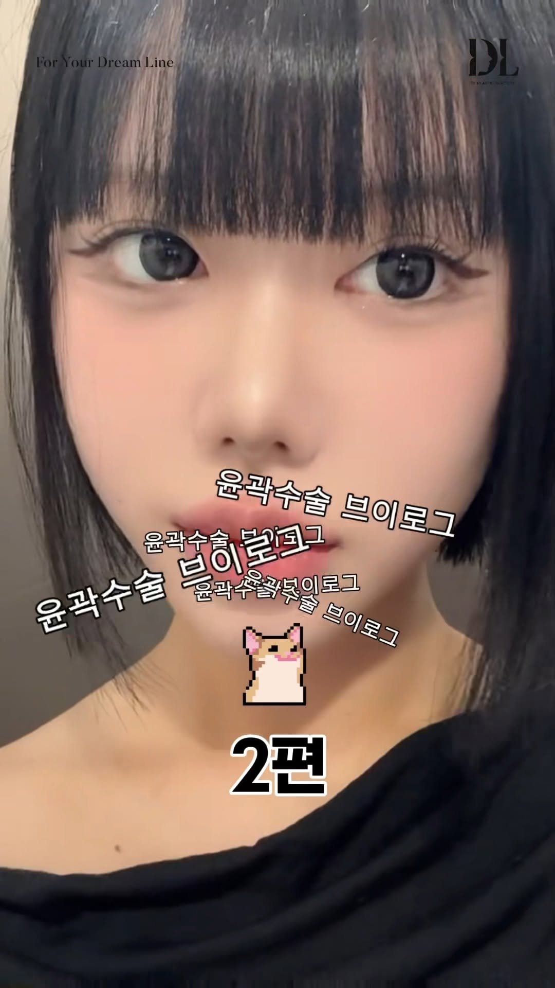 dl_plastic_official 게시물 이미지: 윤곽수술 뿌이로그 2편 🧚🏻‍♀️ 수술 정보가 궁금하다면 댓글에 ‘디엘’이라고 남겨주세요!