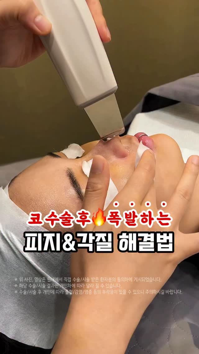 doctorhan_edition 게시물 이미지: 코 수술 7일차, No피지 No각질 실화? 댓글에 ’각질‘ 적어주시면 정보...