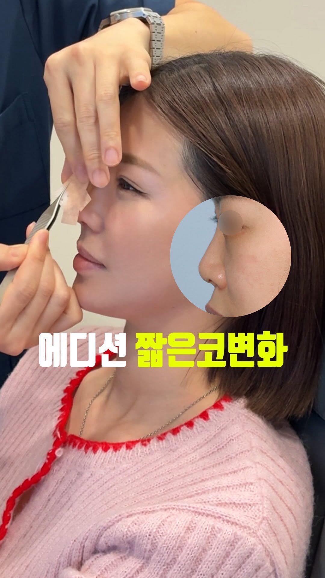 doctorhan_edition 게시물 이미지: 코끝 방향 하나로 달라졌습니다. 

입은 건드리지 않았는데
입매 느낌까지 달라진...