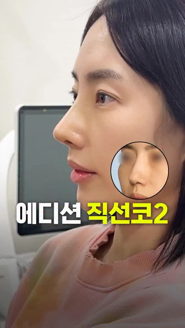 doctorhan_edition 게시물 이미지: 길어 보이던 코라인은 자연스럽게 정리되고, 눈썹이 내려와 가려졌던 쌍꺼풀 라인은...
