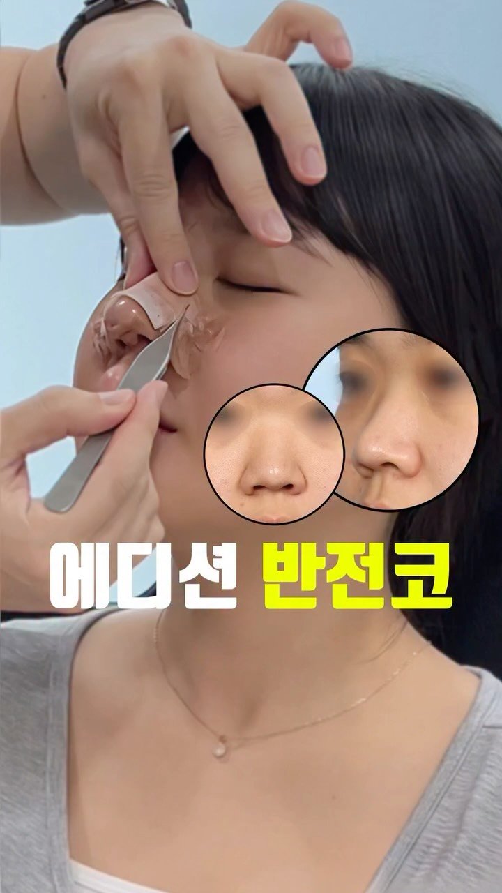 doctorhan_edition 게시물 이미지: 넓고 둔해 보이는 코, 이렇게 달라집니다. 댓글에 ’반전코‘적어주시면 정보...