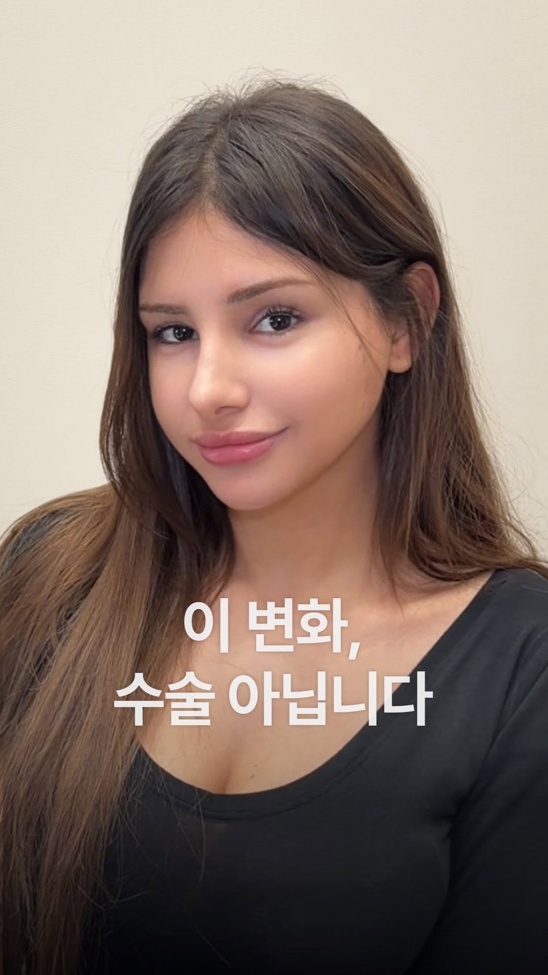 doctorhan_edition 게시물 이미지: 수술 없이 만든 직후 변화입니다. 

필러도, 
보형물도,
레이저도...