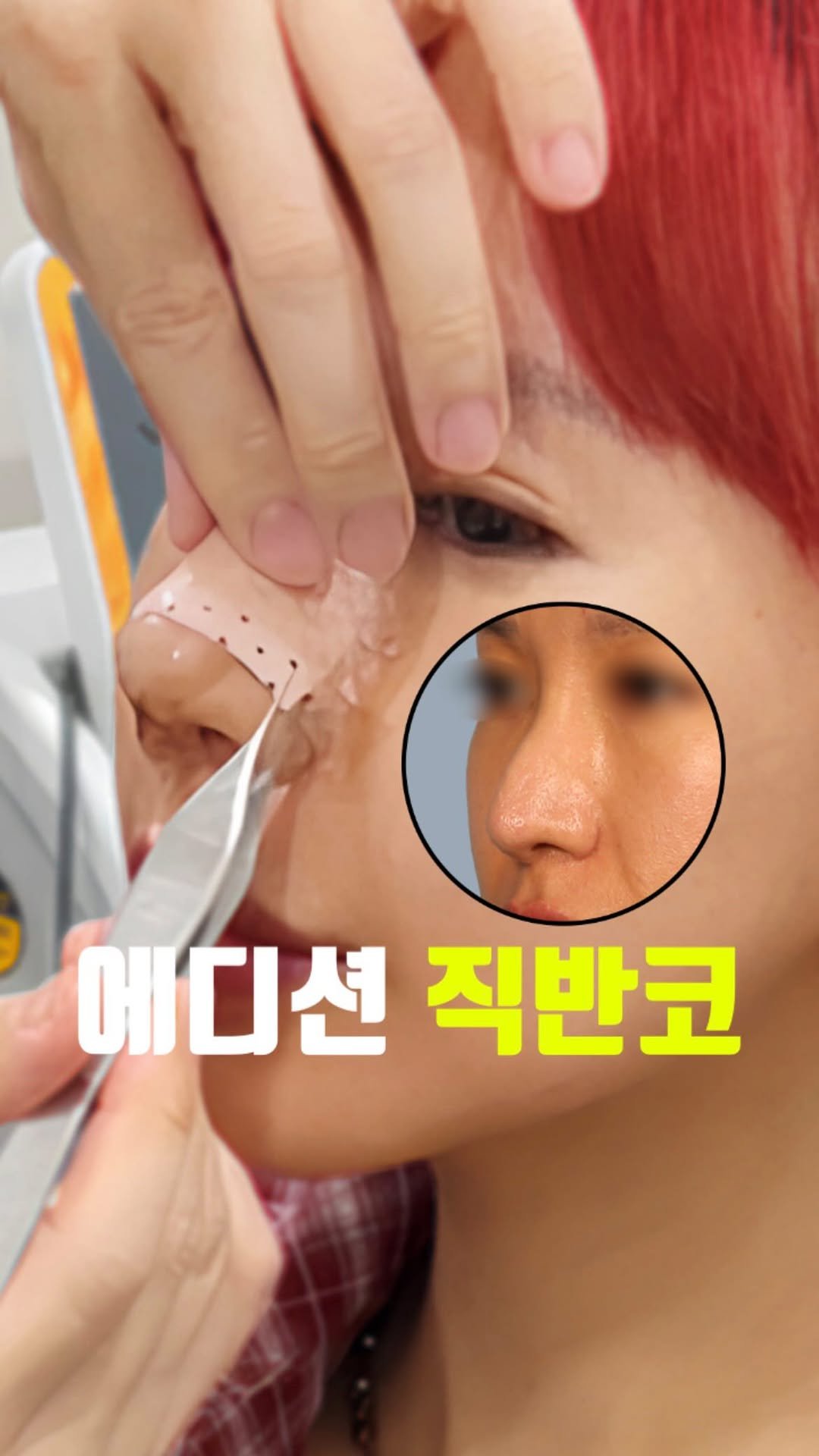 doctorhan_edition 게시물 이미지: 계속 보게 만드는 20초 변화 #비포애프터

”그래서 뭐 하신거에요?“
”재수술도...