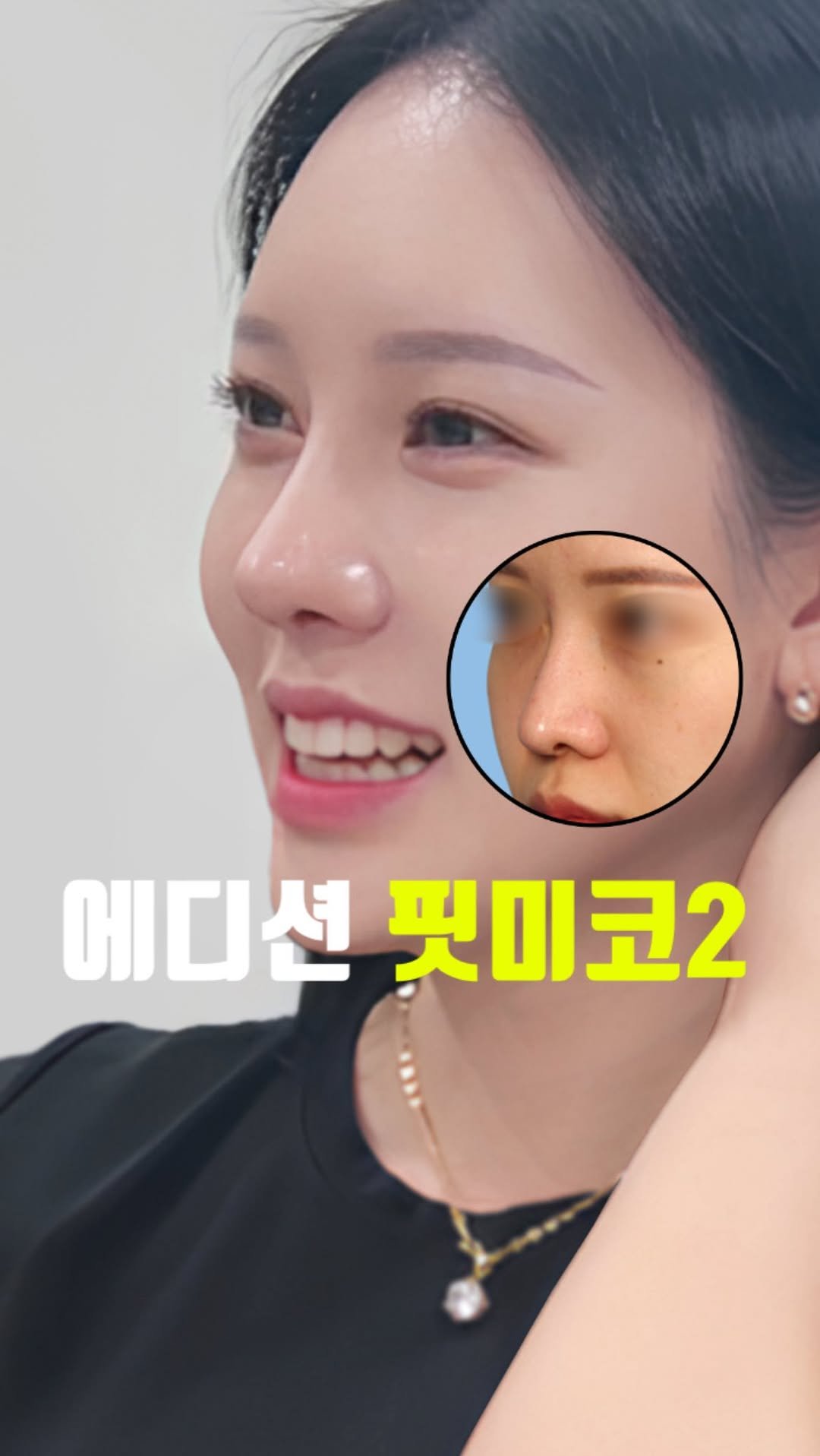 doctorhan_edition 게시물 이미지: 정면,측면 다 예쁜 코 라인 #비포에프터 지금 바로 릴스에서...