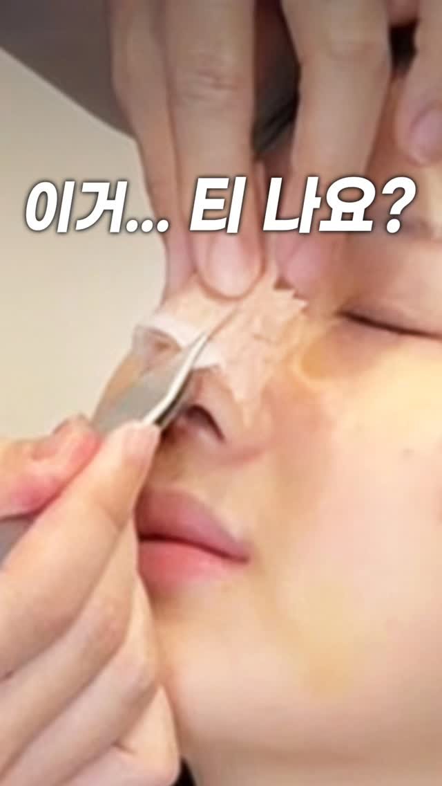 doctorhan_edition 게시물 이미지: 자연스러운데 여성스럽게 원해요 

부목 제거 직후 1주차와 
2주차 경과...