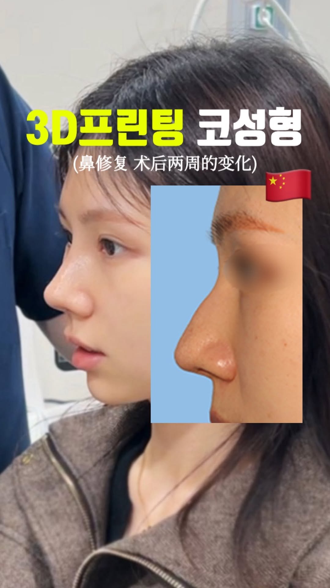 doctorhan_edition 게시물 이미지: 댓글에 [쓰리디] 라고 남겨주세요
3D프린팅으로 맞춘 코라인 정보...