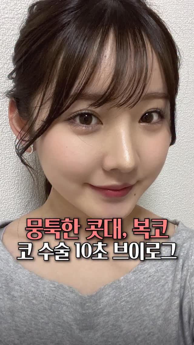 doctorhan_edition 게시물 이미지: 보형물 없이 완성된 복코교정 케이스 #복코교정
　　　
코끝이 퍼져 보이거나 둔한...