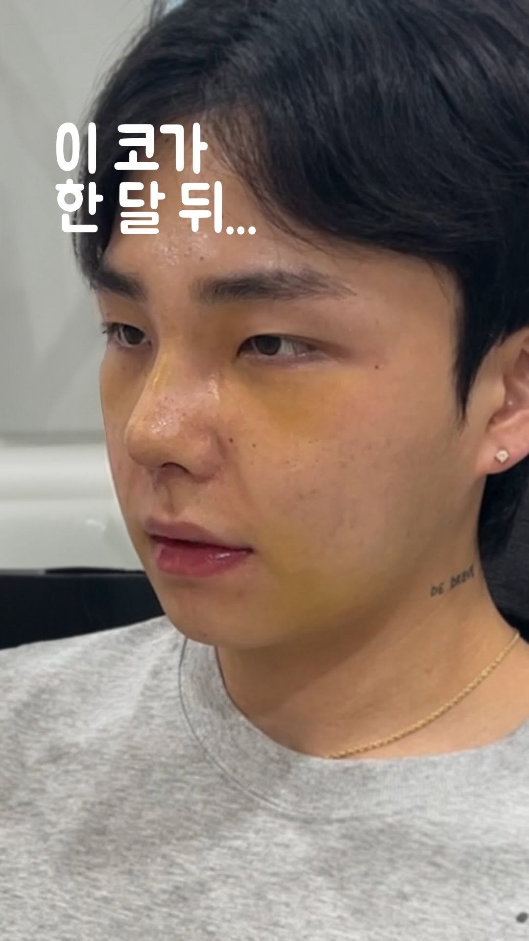 doctorhan_edition 게시물 이미지: 이 코, 한 달 뒤 어떻게 됐을까요? 
　
직선코를 원하셨던 환자분의 1주차,...