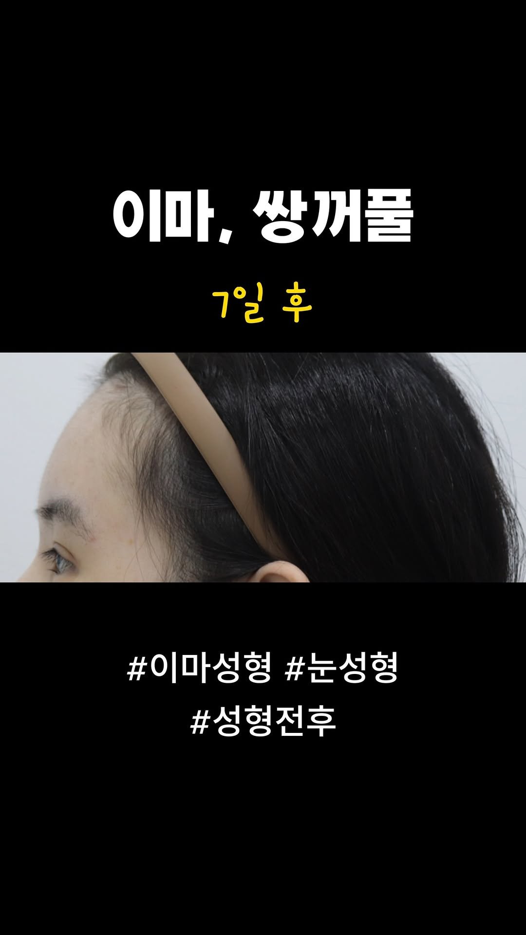 doctorsmips 게시물 이미지: 이마성형, 쌍꺼풀 후기

#닥터스미성형외과 #성형후기 #성형전후 #눈성형 #쌍꺼풀...