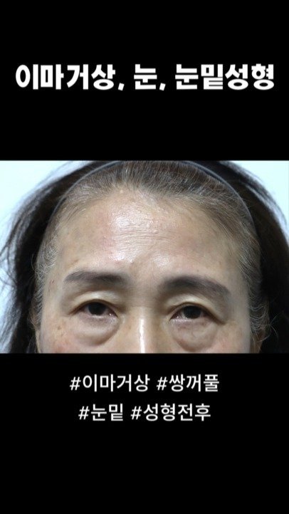 doctorsmips 게시물 이미지: 이마거상, 쌍꺼풀, 눈밑 성형전후 

#닥터스미 #성형전후 #성형외과 #이마거상...