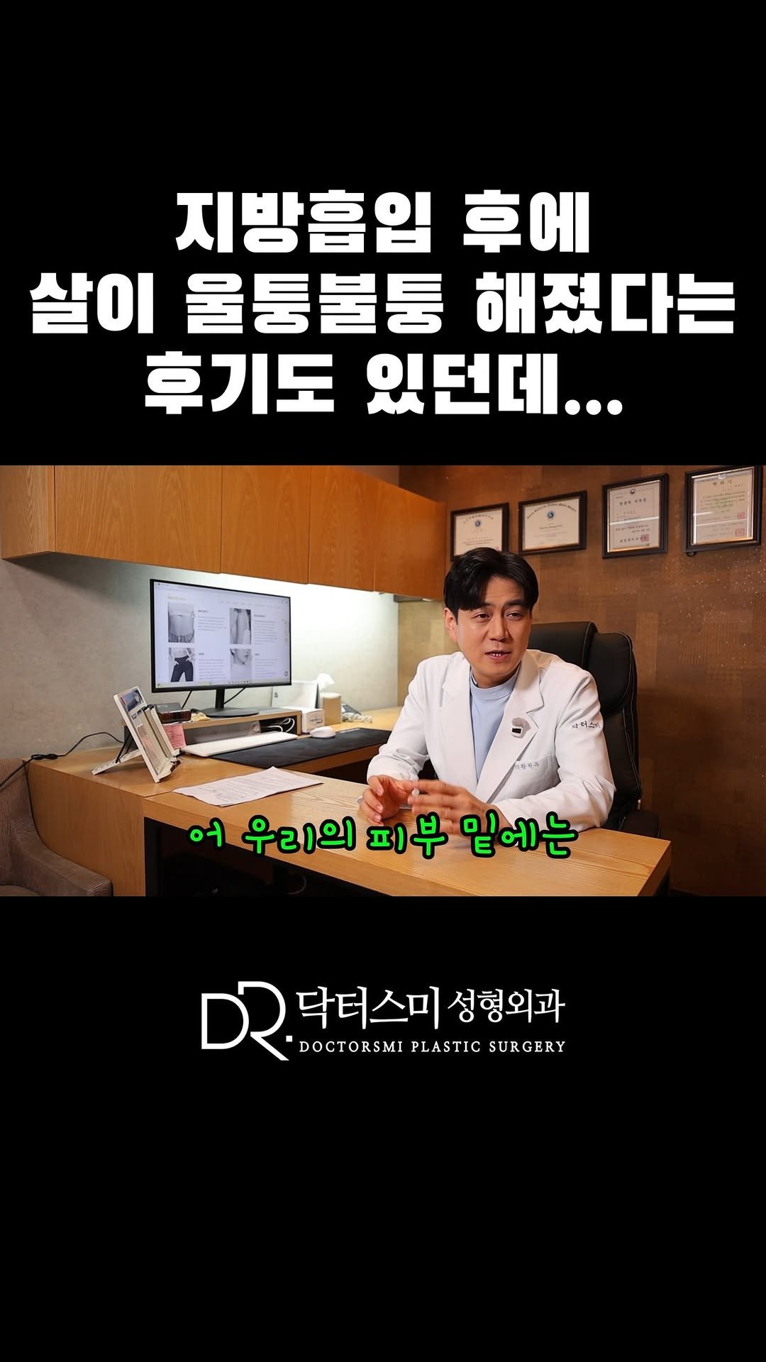 doctorsmips 게시물 이미지: 지방흡입 후에 살이 울퉁불퉁 해졌다는 후기도 있던데...

#닥터스미성형외과 #요요...