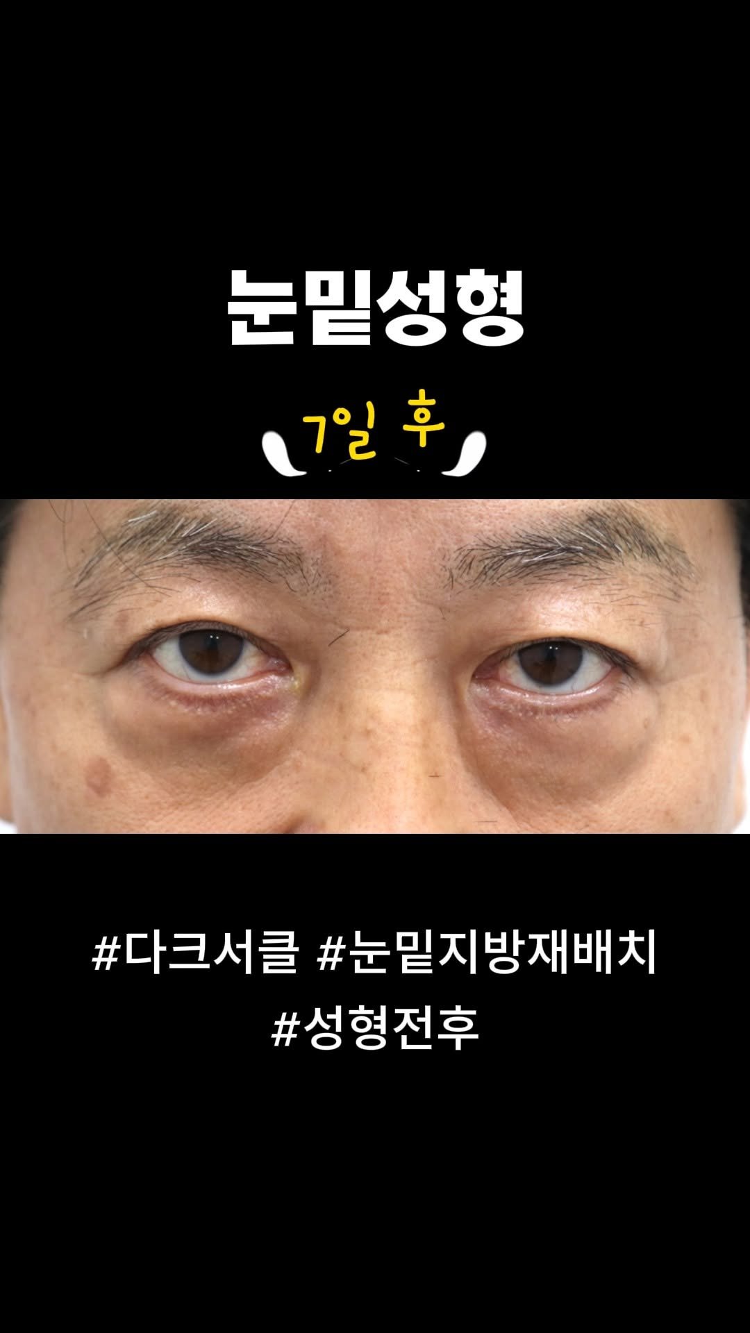 doctorsmips 게시물 이미지: 눈밑성형 성형전후

#닥터스미성형외과 #다크서클 #눈밑지방재배치 #눈밑지방재배치후기 #눈밑성형