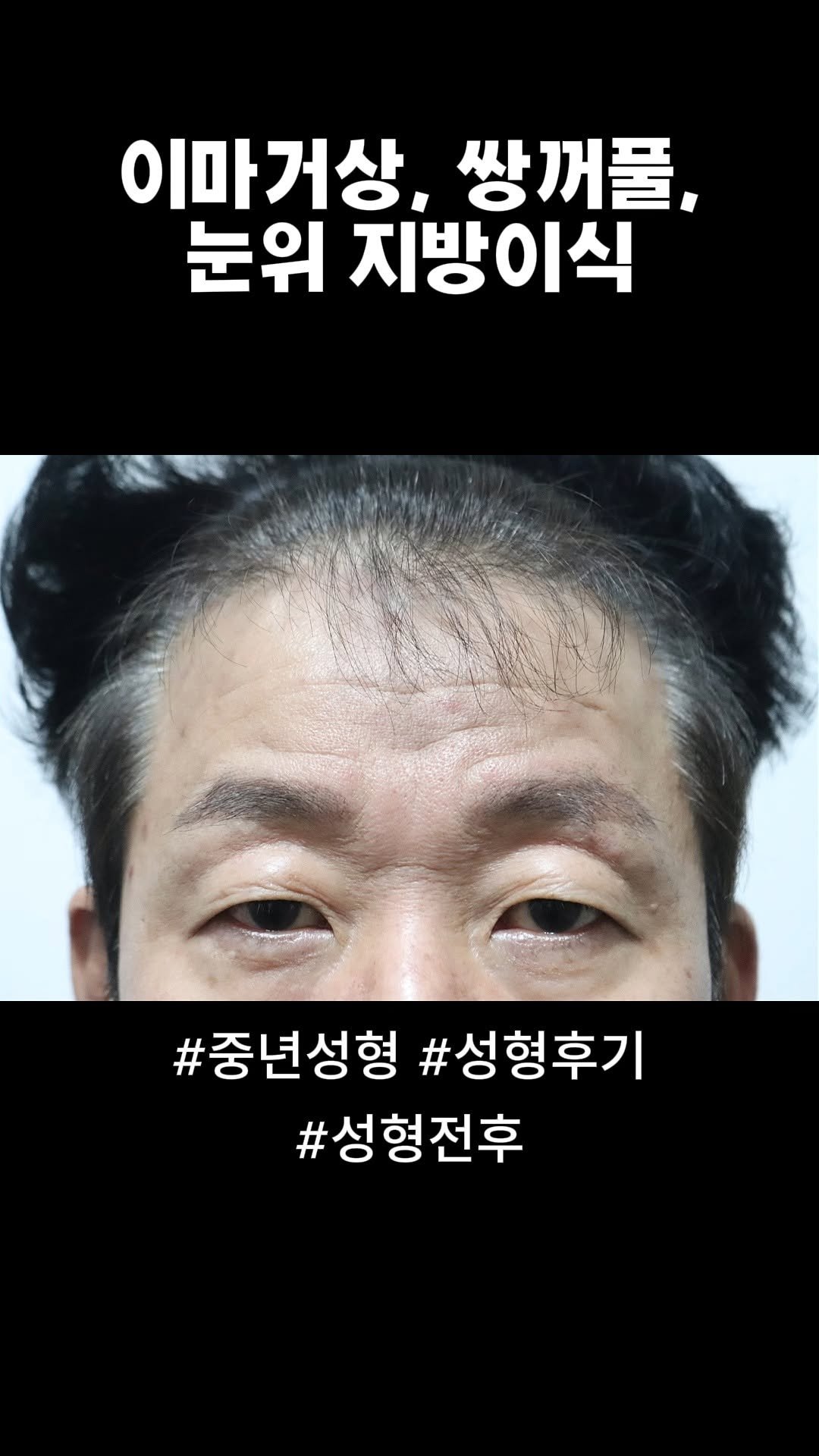 doctorsmips 게시물 이미지: 이마거상, 쌍꺼풀, 눈위 지방이식...