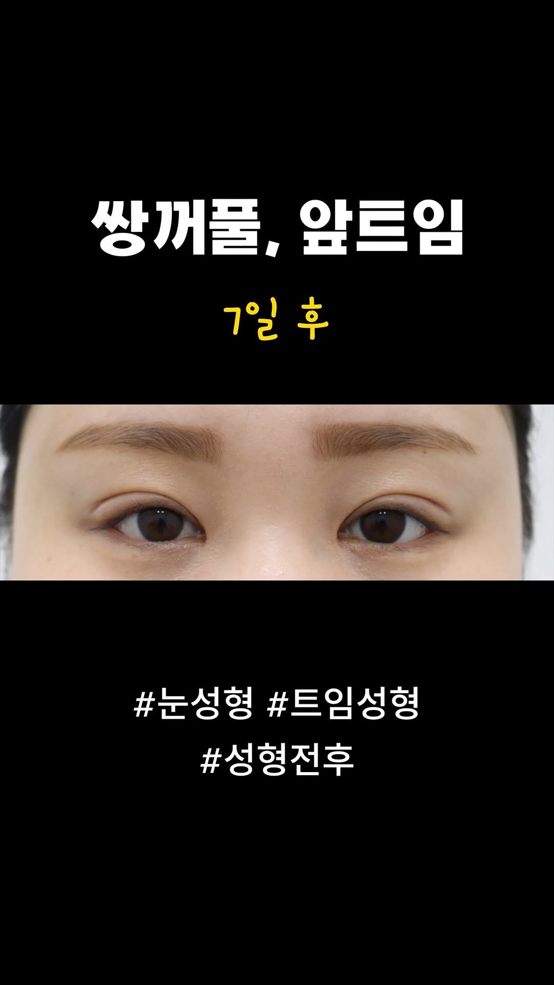 doctorsmips 게시물 이미지: 쌍꺼풀 눈트임 후기 

#닥터스미성형외과 #성형후기 #눈성형 #쌍꺼풀 #쌍수후기...