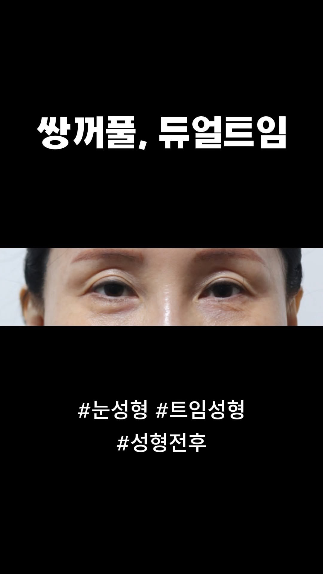doctorsmips 게시물 이미지: 쌍꺼풀, 듀얼트임 눈성형 후기 

#닥터스미성형외과 #성형후기 #쌍꺼풀 #쌍꺼풀수술...